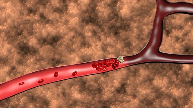 Animation of the formation of thrombosis