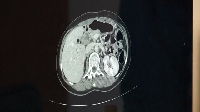 Three head views of MRI scan, MRI brain scan on black background, Computed Tomography Abdomen (CT SCAN)