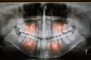 embedded impacted 4 bicuspid teeth on X-ray film