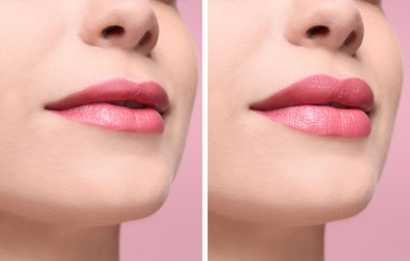 Woman before and after lips augmentation procedure, closeup. Cosmetic surgery