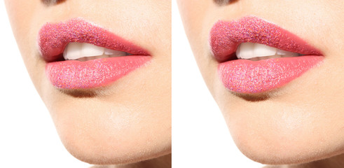 Woman before and after lips augmentation procedure, closeup. Cosmetic surgery