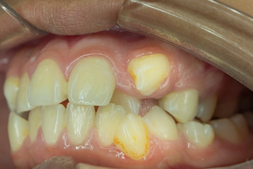 crowding tooth on upper jaw © trailak