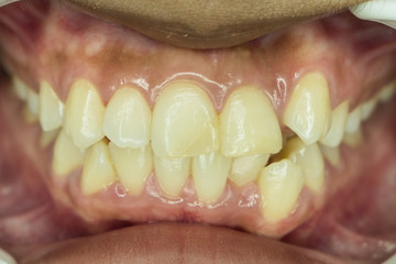 Obraz premium crowding teeth