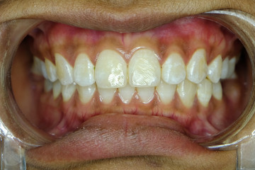 mild fluorosis in front teeth