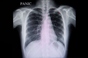 Xray TB lung