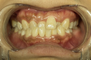cross bite in front teeth