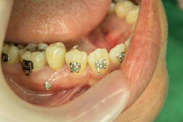 miniscrew in orthodontic treatment