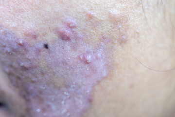 Backgrounds of lesions skin caused  by acne on the face in the clinic.