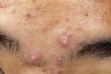 Fototapeta premium Backgrounds of lesions skin caused by acne on the face in the clinic.