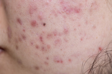 Fototapeta premium Backgrounds of lesions skin caused by acne on the face in the clinic.