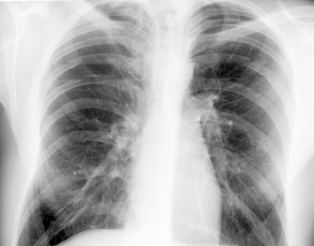 chest or lung x-ray