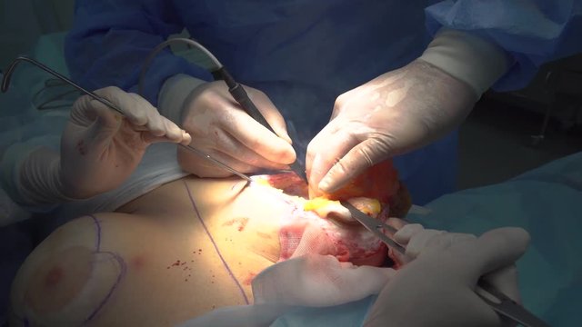Extraction of an old implant from a breast