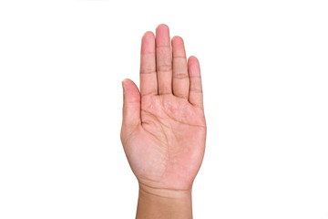 Obraz premium Skin peeling.Closeup of Eczema Dermatitis on hand and fingers.