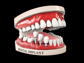 3d illustration of Human teeth and Dental implant isolated black