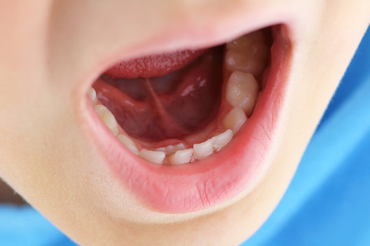 boca de ni&ntilde;o con doble fila de dientes