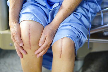 Asian senior or elderly old lady woman patient show her scars surgical total knee joint replacement...