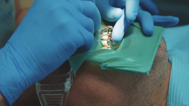 Dentist treating a patient using cofferdam. 4K
