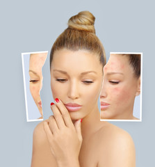 Post-Acne Marks /Treating Acne Scars