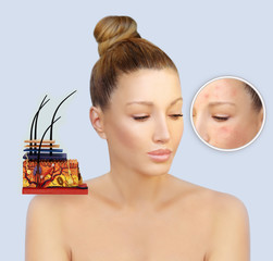Post-Acne Marks /Treating Acne Scars