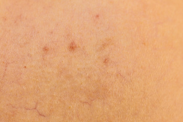 Ski with dilated capillaries ad red spots