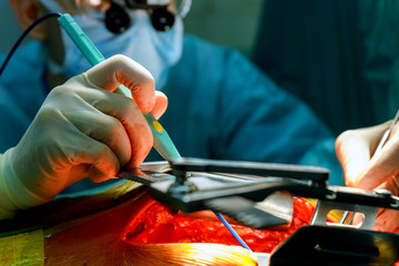 Surgeons working with a scissors on a patient in a operating theater