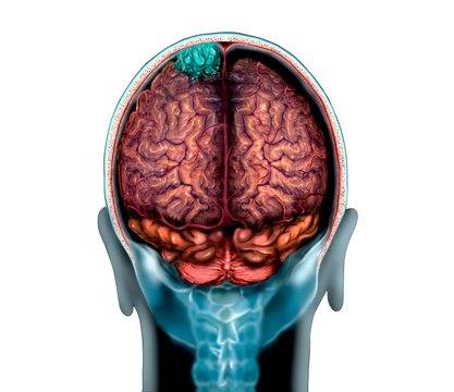 Brain tumour, MRI and illustration
