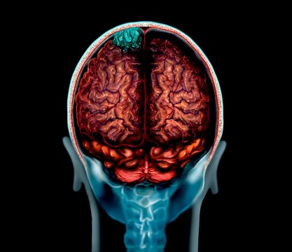 Brain tumour, MRI and illustration