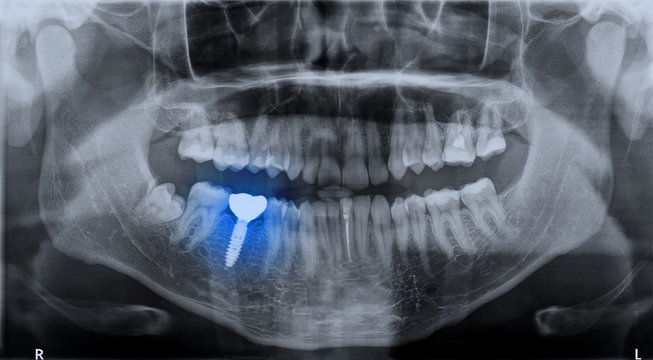 Panoramic dental x-ray image mouth of adult man and single dental implant with crown attached used for tooth replacement, with indicated with treatment area