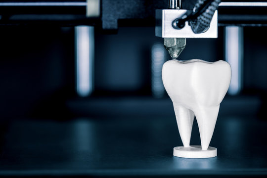 Verwendung eines 3D Druckers in der Zahntechnik oder Zahnmedizin, Zahnprothese wird durch fused filament fabrication hergestellt