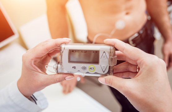 Doctor With An Insulin Pump Connected In Patient Abdomen And Holding The Insulin Pump At His Hands.