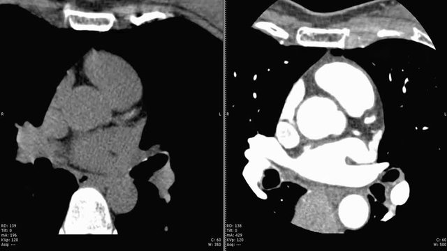 Coronary CT Angiography , computed tomography angiography ( CTA ) coronary angiogram Axial view non contrast media vs with contrasrt media.