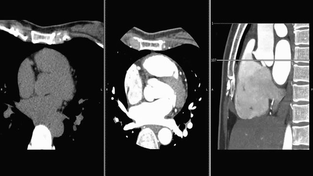 Coronary CT Angiography , computed tomography angiography ( CTA )  Axial view non contrast media vs with contrasrt media and sagittal view.