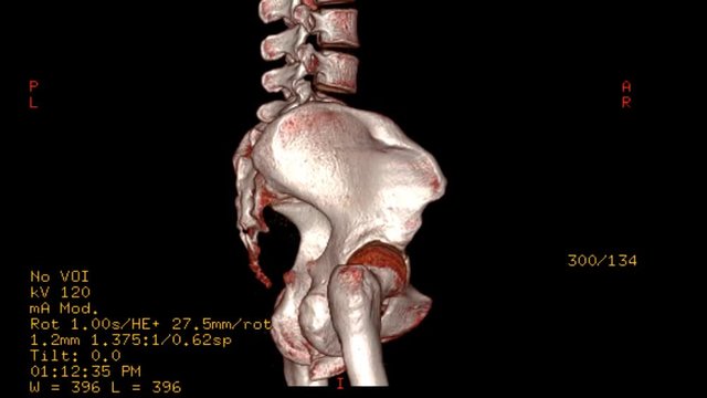 CT SCAN image of pelvic bone 3D rendering image demonstrate fracture pelvic bone . Rotating on monitor .