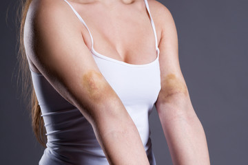 Bruises on the woman's hands, arms with extensive hematoma