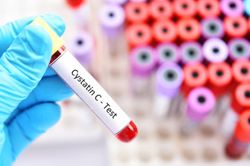 Obraz premium Blood sample tube for cystatin C test, diagnosis for renal disease 