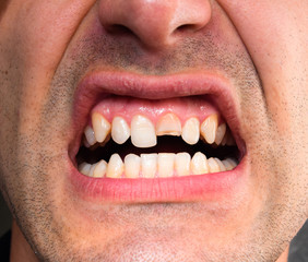 Broken tooth. Broken upper incisor in a man mouth. Man shows oral cavity to the dentist. Treatment...