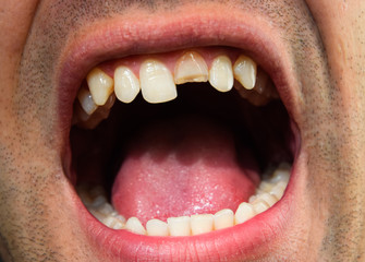 Obraz premium Broken tooth. Broken upper incisor in a man mouth. Man shows oral cavity to the dentist. Treatment of a broken tooth.