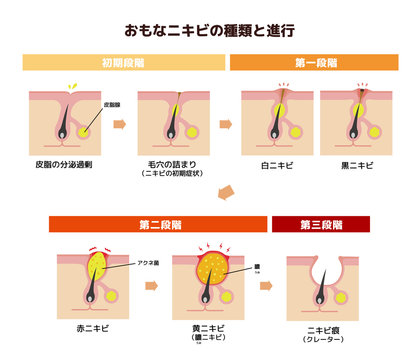 おもなニキビの種類と症状の進行　イラスト(日本語)