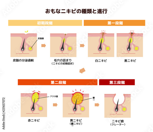 おもなニキビの種類と症状の進行 イラスト 日本語 Wall Mural Barks