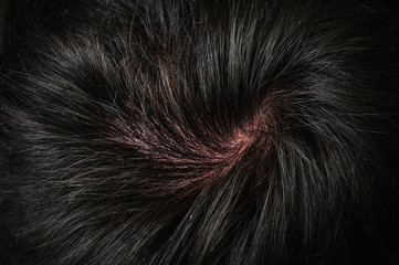 Closeup view of hair of a man with dandruff