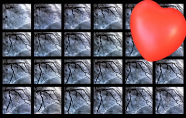 Catheterization. Cardiac ventriculography and small red heart
