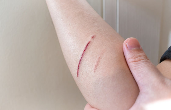 Fresh Wound of Deep Skin Scratch on the Forearm .