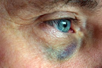 The face of a man with a bruise under his eyes. Close-up. Selective focus.