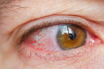 Closeup irritated infected red bloodshot eyes, conjunctivitis