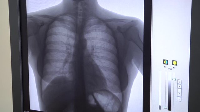 fluorography of lungs on a computer monitor 