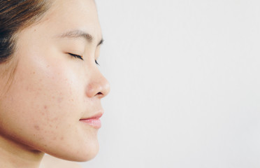 Half face of Asian woman has acne problems on her face.