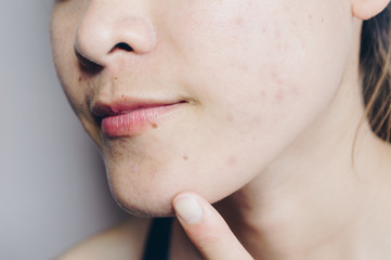 Obraz premium Close-up of Asian woman has problems with skin on her face. Problems with acne and scar on the female skin.