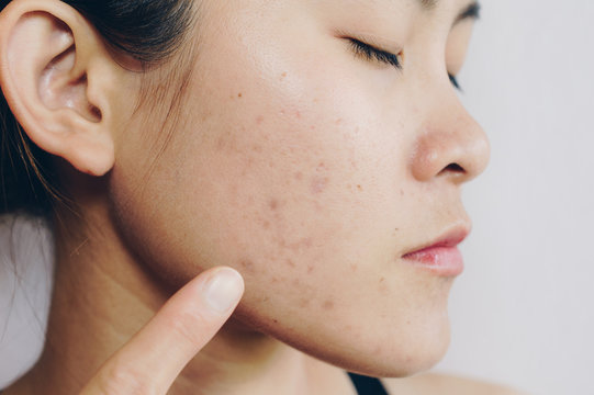 Asian woman has acne problems on her face.