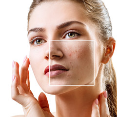 Young woman with acne skin in zoom square.