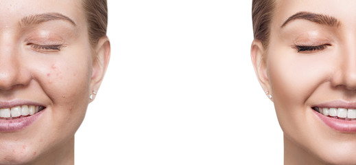 Woman with acne before and after treatment and make-up.